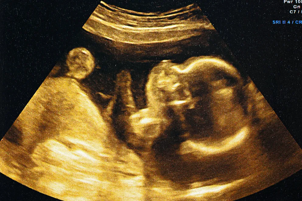 Échographie d'un embryon | photo : Getty Images